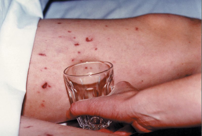 Meningococcal Infection – St Patrick’s Primary, Legamaddy