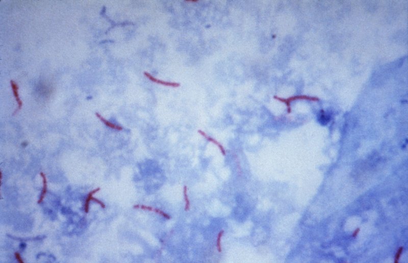 Tuberculosis still proving a threat in Northern Ireland
